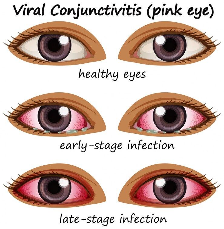 Why Your Eye Might Be Red: More Than Pink Eye