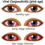 Why Your Eye Might Be Red More Than Pink Eye