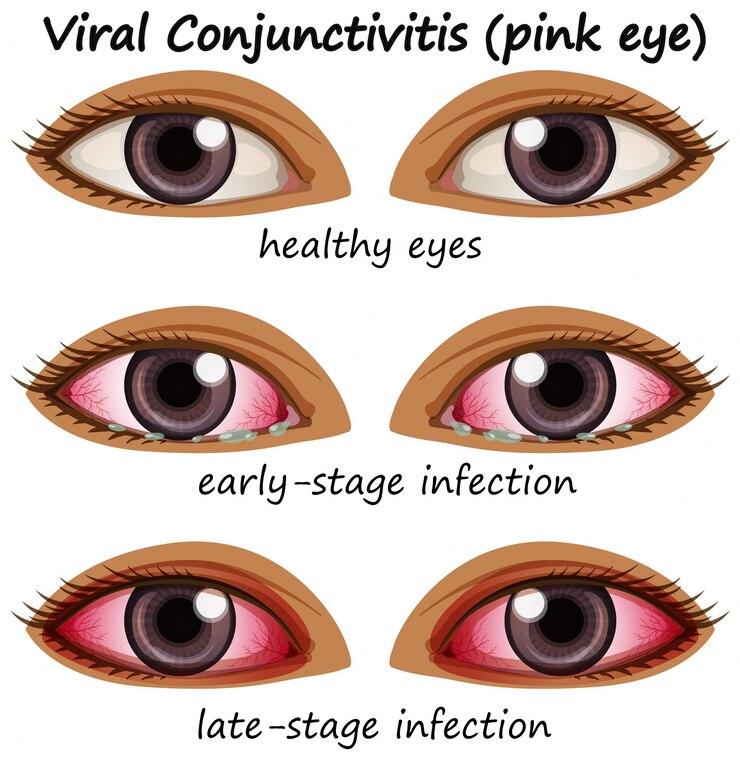 Why Your Eye Might Be Red More Than Pink Eye